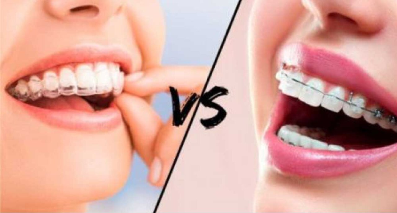 Braces Vs Aligners 
